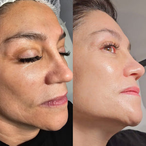 Suero Botox Anti Arrugas - SkinLift 21